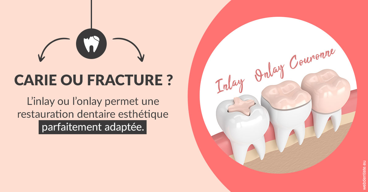 https://scp-stricker-rozensztajn-doux.chirurgiens-dentistes.fr/T2 2023 - Carie ou fracture 2