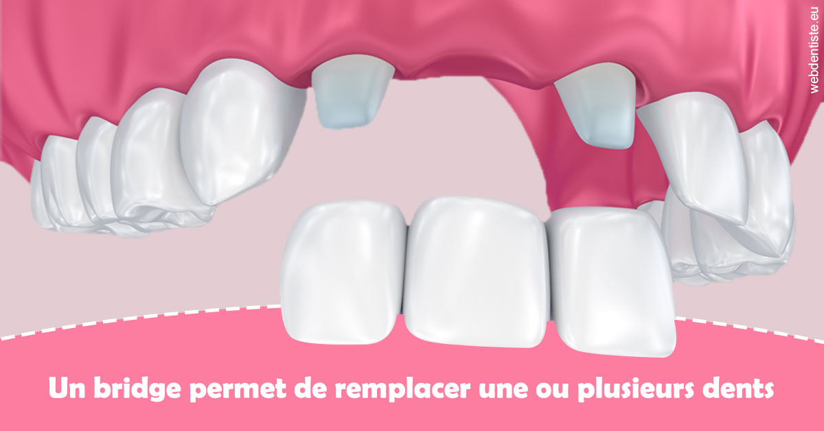 https://scp-stricker-rozensztajn-doux.chirurgiens-dentistes.fr/Bridge remplacer dents 2
