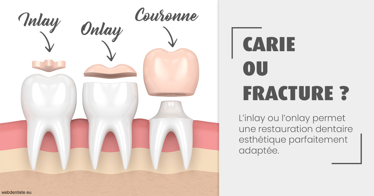 https://scp-stricker-rozensztajn-doux.chirurgiens-dentistes.fr/T2 2023 - Carie ou fracture 1