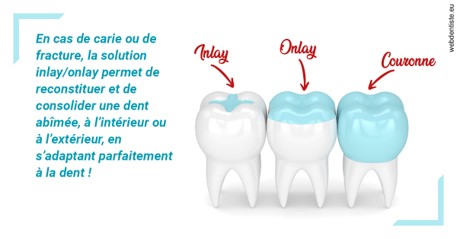 https://scp-stricker-rozensztajn-doux.chirurgiens-dentistes.fr/L'INLAY ou l'ONLAY