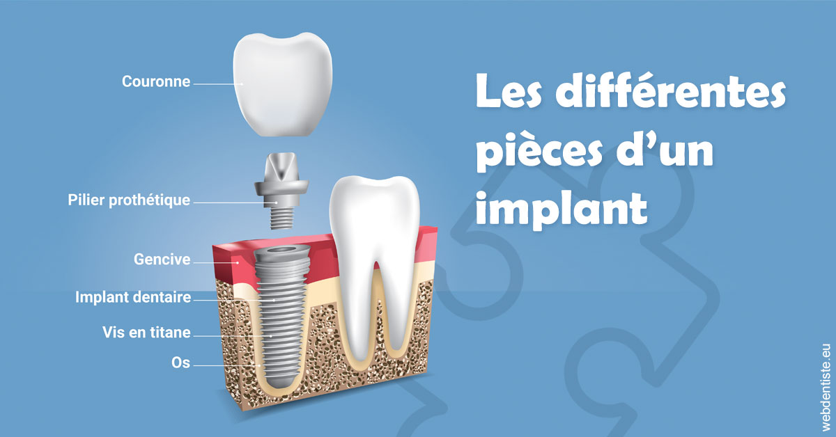 https://scp-stricker-rozensztajn-doux.chirurgiens-dentistes.fr/Les différentes pièces d’un implant 1